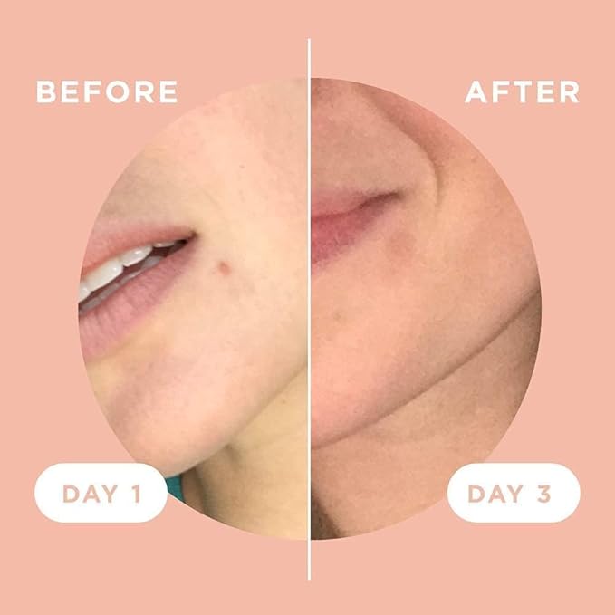 ZitSticka Killa Pimple Patches for Face - World's Most Potent Pimple Patch with Fast-Acting Microdarts - Starts Working within 6 Hours for Deep, Early-Stage Zits - Regular 12 Count with Cleana Swab