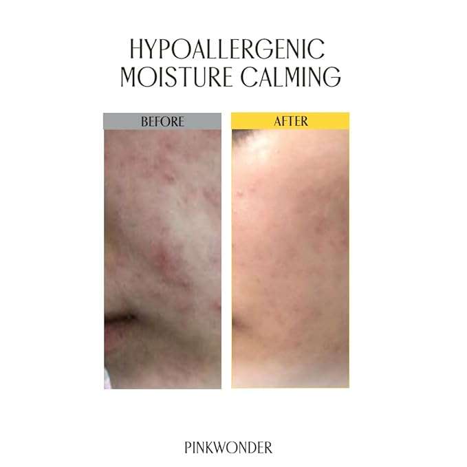 PINKWONDER Tamanu Hero Calming Gel 5.07oz (150ml) | Organic Tamanu Gel, Cooling, Soothing Instant Relief for Skin & Sunburn, Sunburn Relief, Alcohol Free, Gel cream, Korean Skincare