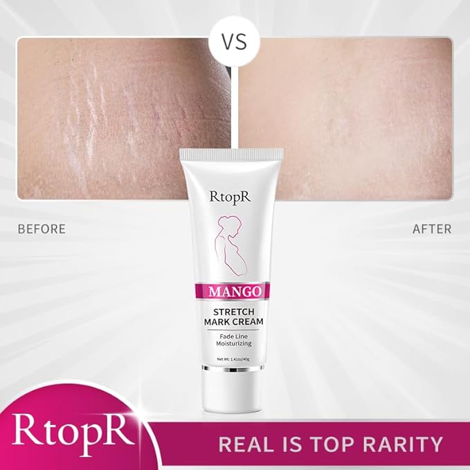 RtopR Mango Stretch Mark Cream for Pregnancy, Stretch Mark Repair Cream, Fade Line, Moisturizing and Non-Greasy, Safe to Use When Pregnant