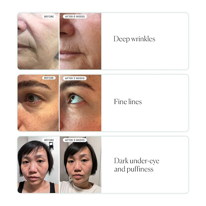Qure Skincare MicroInfusion Targeted Patches - 8 Pairs of Targeted Under Eye Patches Formulated for Fine Lines & Wrinkles - Retinol, Caffeine, Niacinamide & Peptides - Dissolvable for Overnight Use