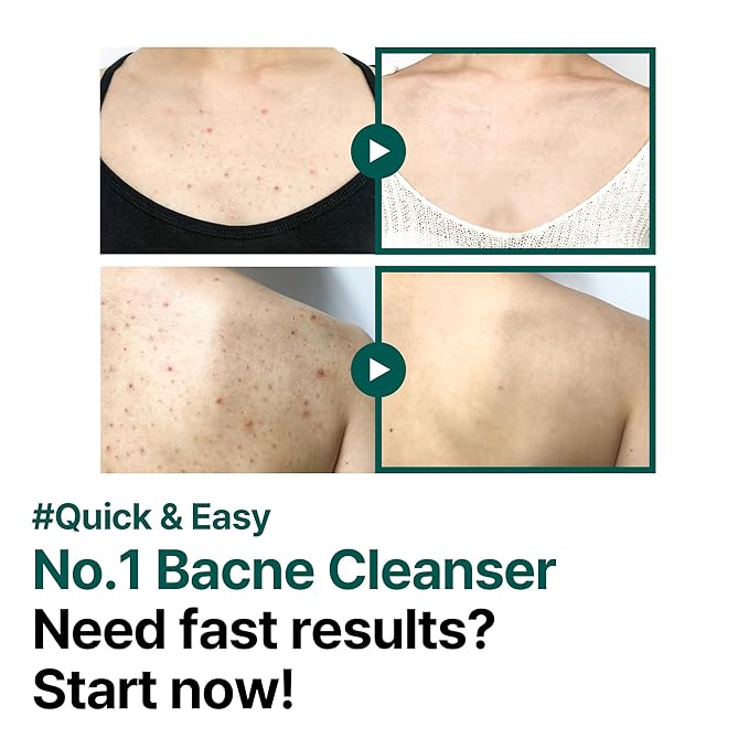 SOME BY MI AHA BHA PHA 30 Days Miracle Acne Clear Body Cleanser - 13.5oz, 400ml - Daily Exfoliating Tea Tree Acne Body Wash with Salicylic Acid - Deep Cleanses Sebum and Impurities - Korean Skin Care