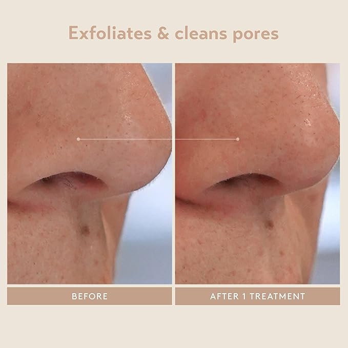 SHANI DARDEN SKIN CARE Triple Acid Peel, 2-Step Exfoliating Face Peel with Mandelic, Lactic & Glycolic Acids, Kaolin Clay Neutralizing Mask & Brush, Helps Improve Dark Spots & Skin Texture, 1.69 fl oz